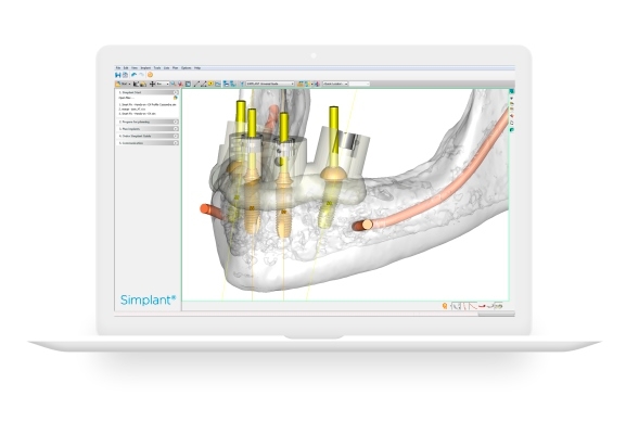 SIMPLANT PLANNER PLUS SOFTWARE